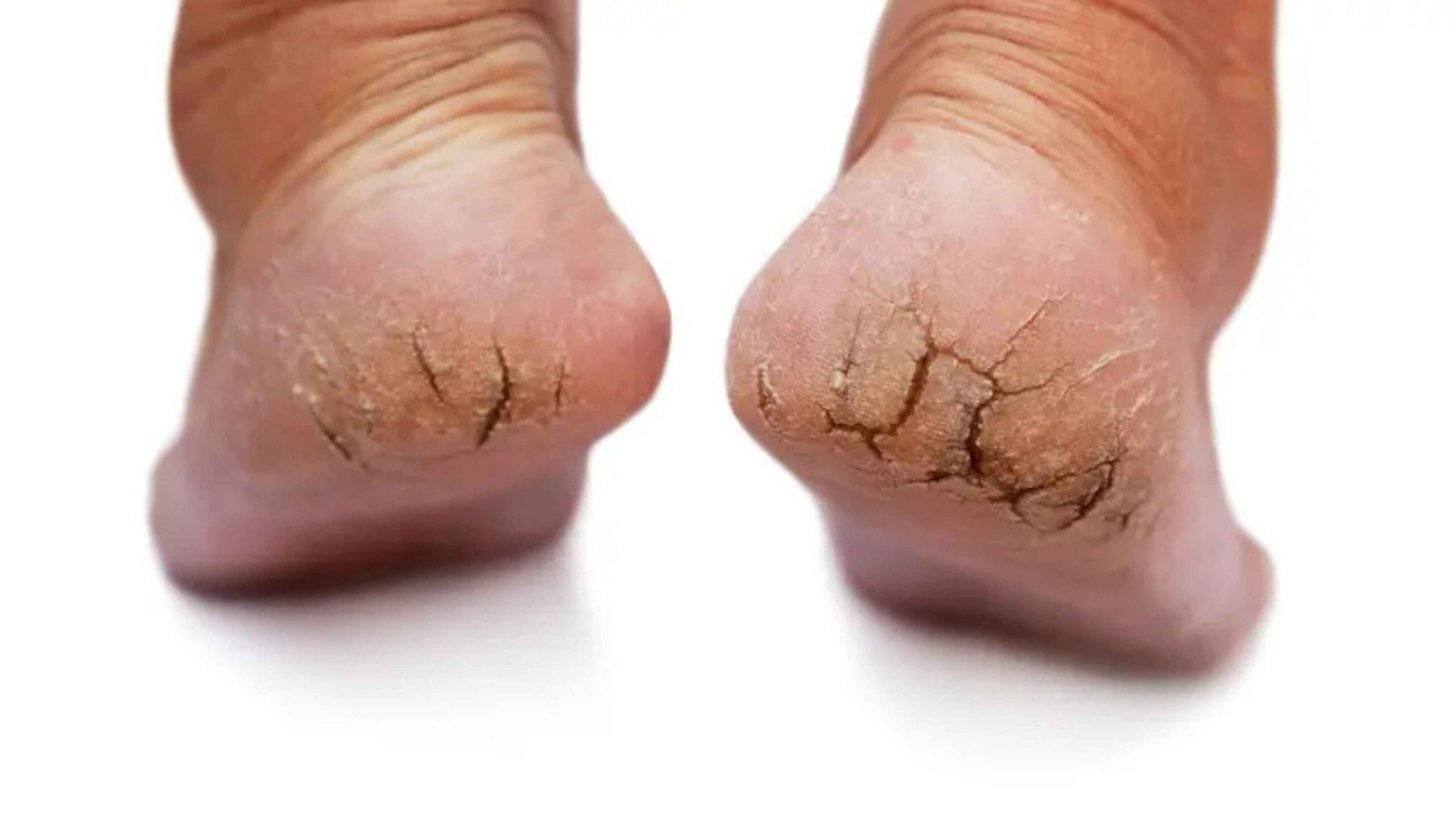 Bye Tumit Pecah! Ini Cara Merawat Telapak Kaki agar Lembut & Cerah