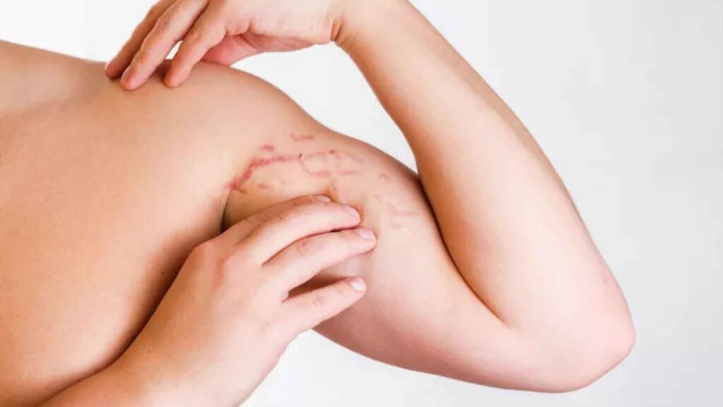 Stretch Mark Membandel? Ini Trik Alami yang Jarang Diketahui Orang