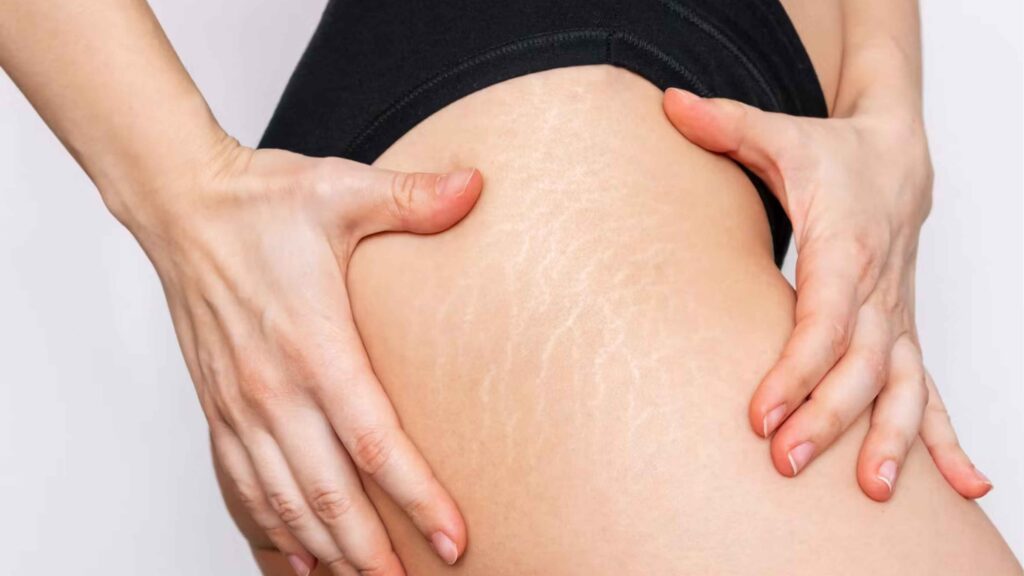 Stretch Mark Membandel? Ini Trik Alami yang Jarang Diketahui Orang