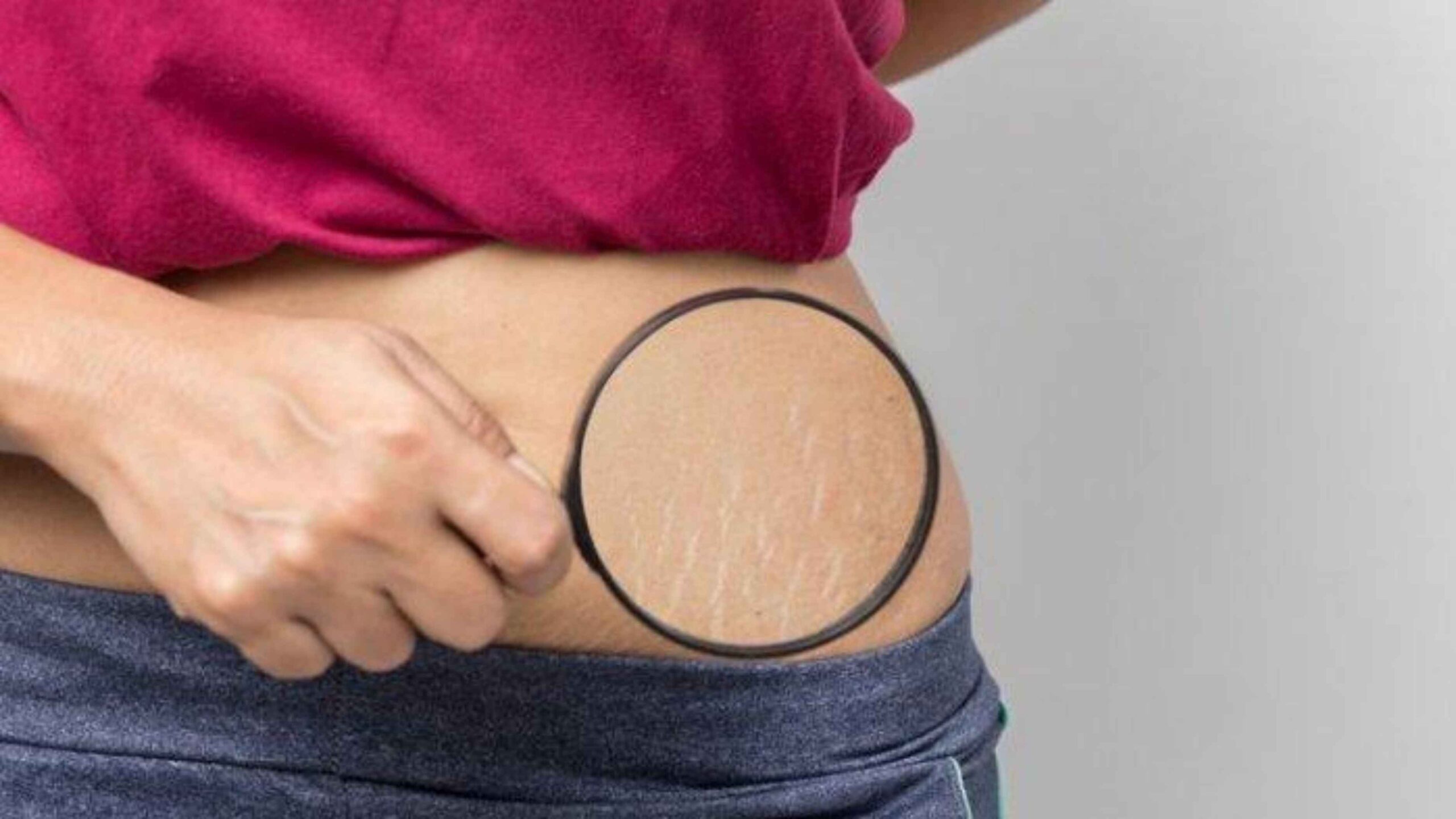 Stretch Mark Membandel? Ini Trik Alami yang Jarang Diketahui Orang