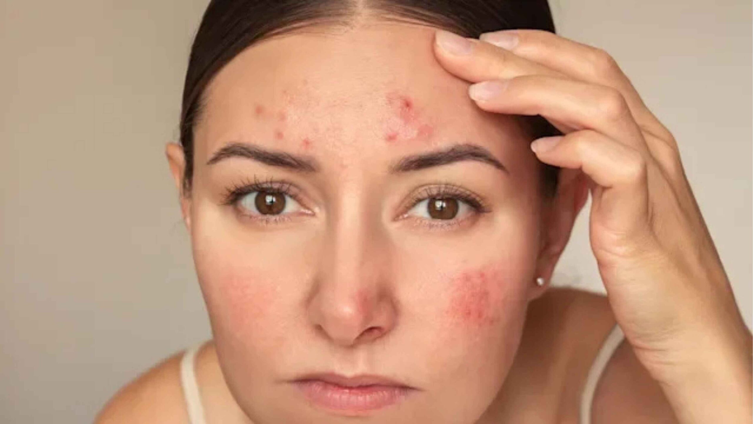 Retinol untuk Kulit Berjerawat