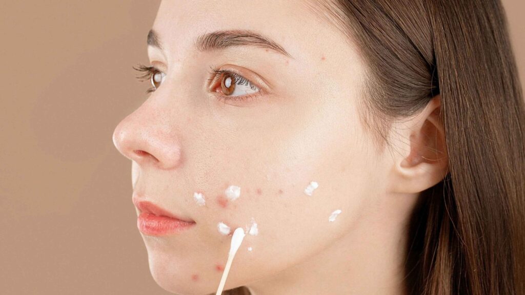 Retinol untuk Kulit Berjerawat