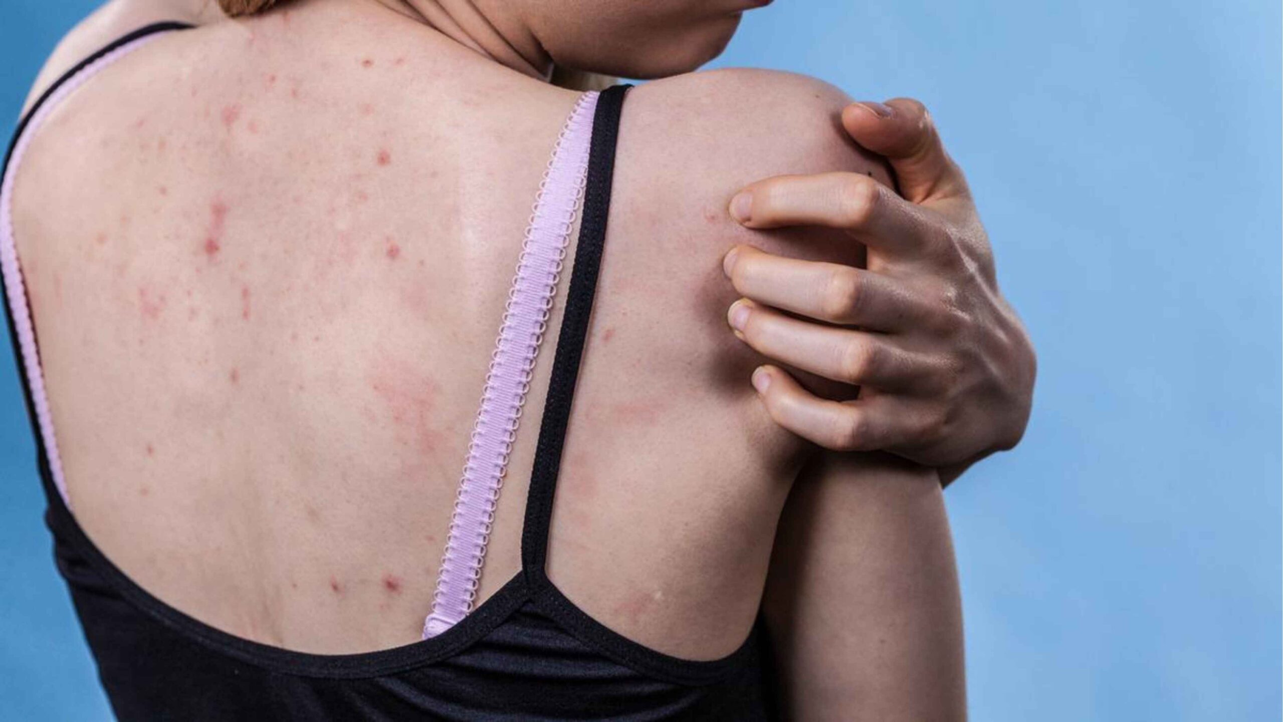 Tips Menghilangkan Back-Acne
