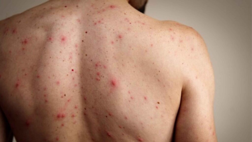 Tips Menghilangkan Back-Acne