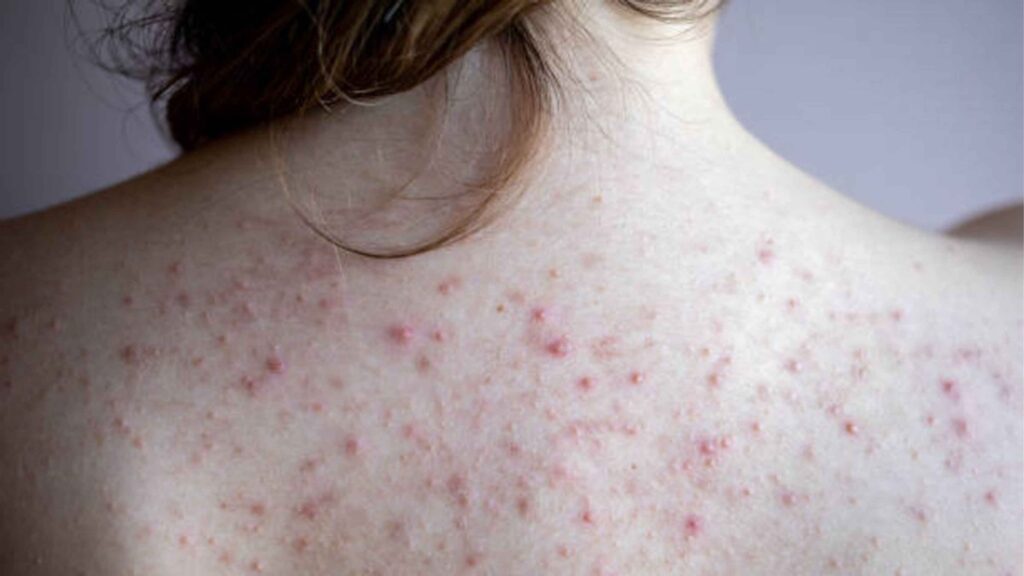 Tips Menghilangkan Back-Acne