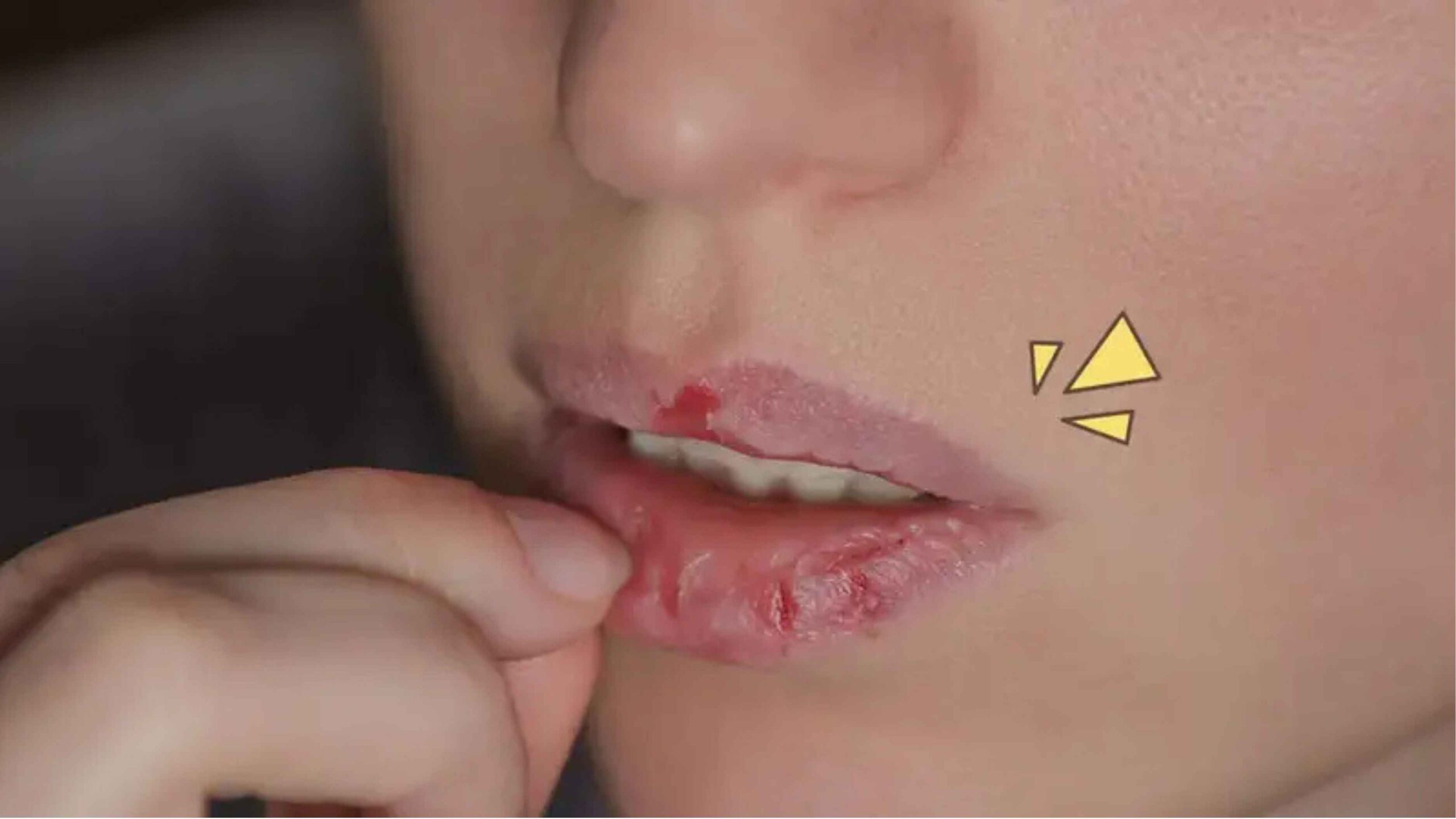 Cara Merawat Bibir Kering